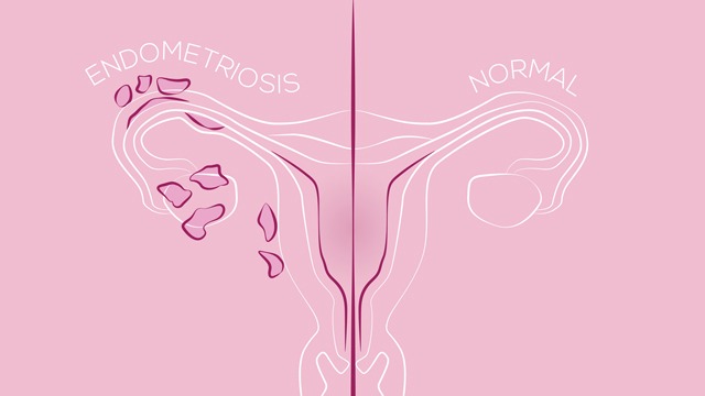 endometrioza